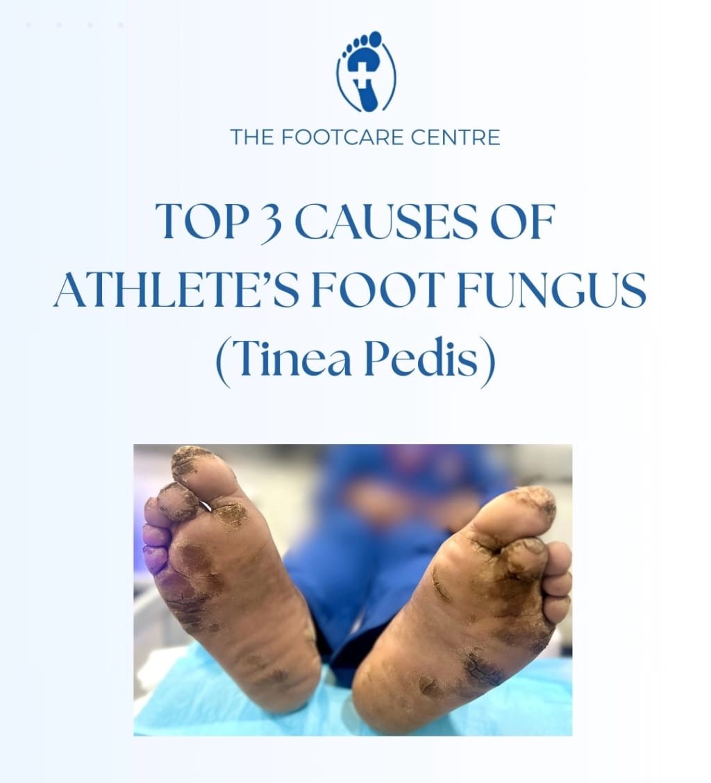 Athlete's Foot (Tinea Pedis)
